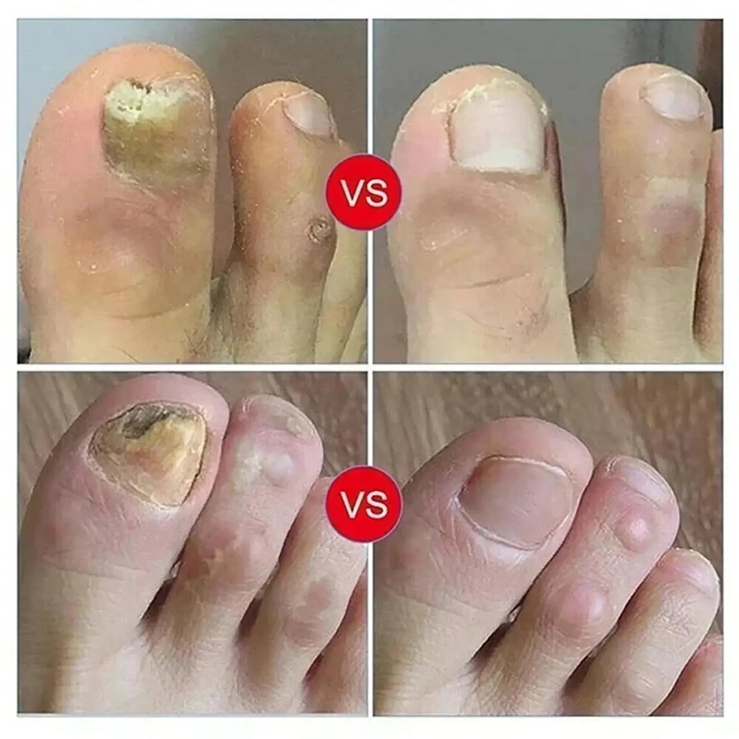 7 Days Fungal Nail Treatment Serum Foot Nail Fungus Removal Repair Gel Anti Infection Paronychia Onychomycosis Foot Nails Care