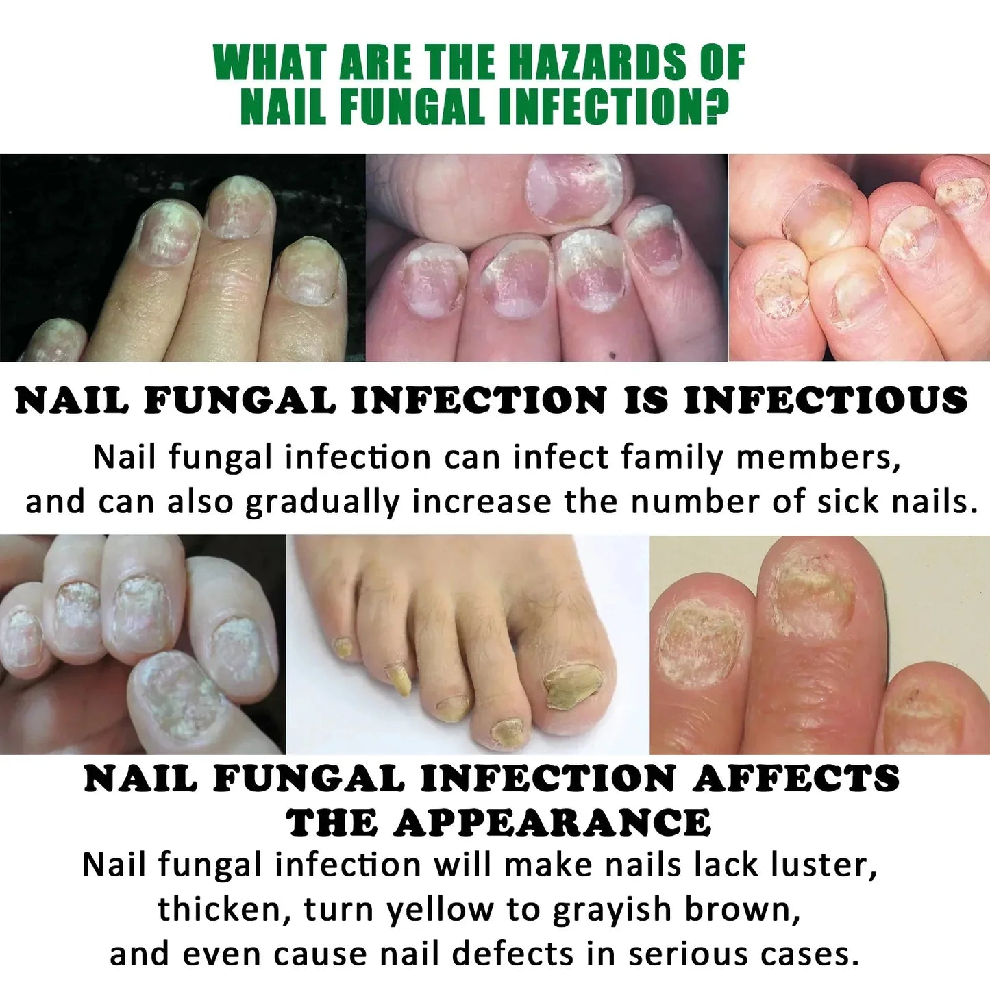7 Days Fungal Nail Treatment Serum Foot Nail Fungus Removal Repair Gel Anti Infection Paronychia Onychomycosis Foot Nails Care