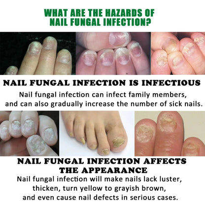 7 Days Fungal Nail Treatment Serum Foot Nail Fungus Removal Repair Gel Anti Infection Paronychia Onychomycosis Foot Nails Care