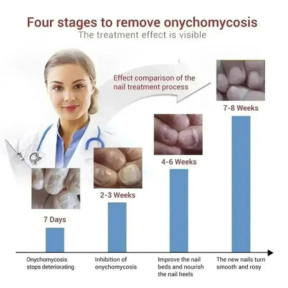 7 Days Fungal Nail Treatment Serum Foot Nail Fungus Removal Repair Gel Anti Infection Paronychia Onychomycosis Foot Nails Care