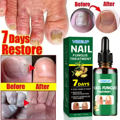 7 Days Fungal Nail Treatment Serum Foot Nail Fungus Removal Repair Gel Anti Infection Paronychia Onychomycosis Foot Nails Care